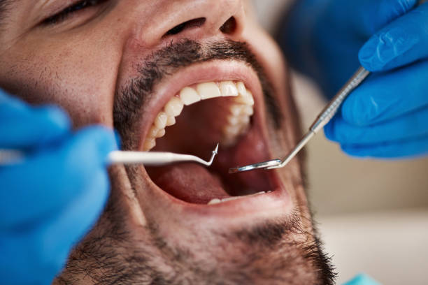 Best Emergency Wisdom Teeth Removal in Marthasville, MO